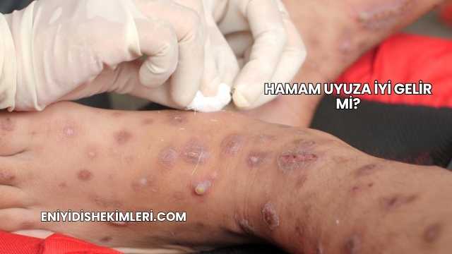 Hamam Uyuza İyi Gelir mi?