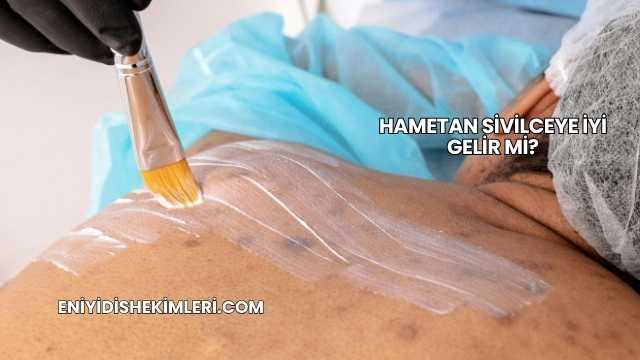 Hametan Sivilceye İyi Gelir mi?