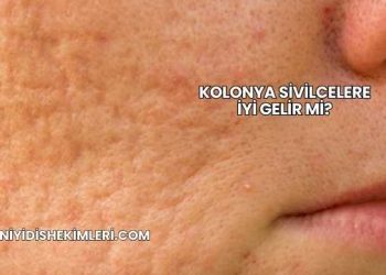 Kolonya Sivilcelere İyi Gelir mi?