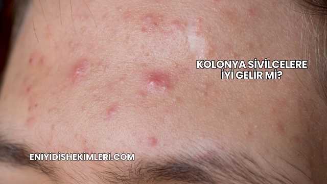 Kolonya Sivilcelere İyi Gelir mi?