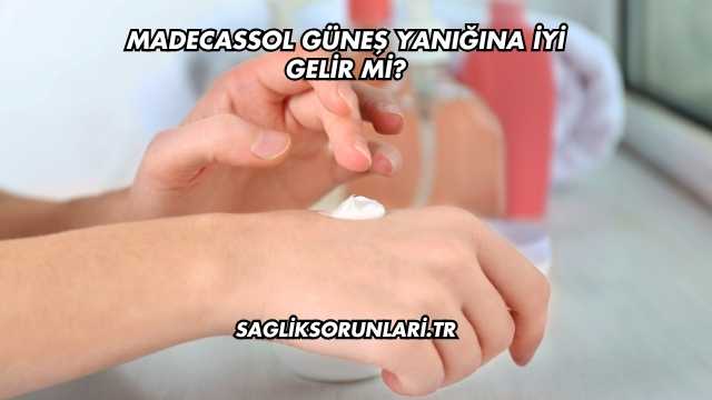 Madecassol Güneş Yanığına İyi Gelir mi?