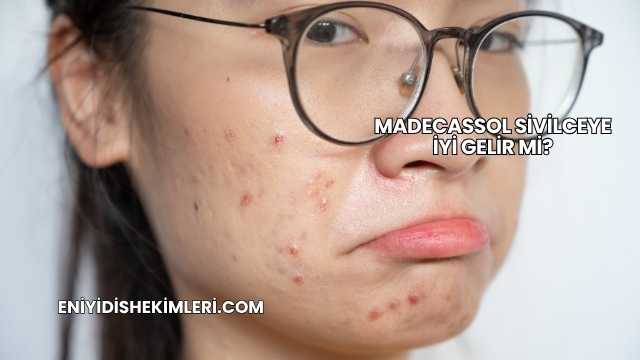 Madecassol Sivilceye İyi Gelir mi?