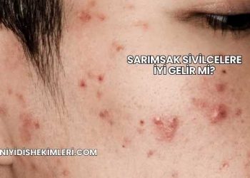 Sarımsak Sivilcelere İyi Gelir mi?