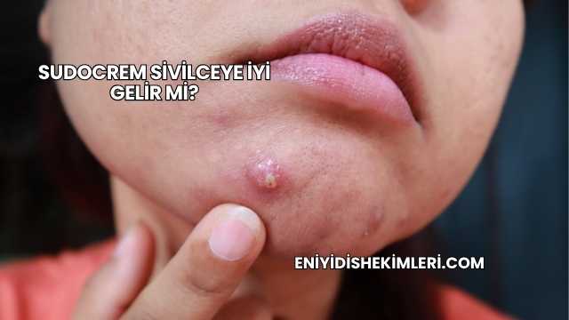 Sudocrem Sivilceye İyi Gelir mi?