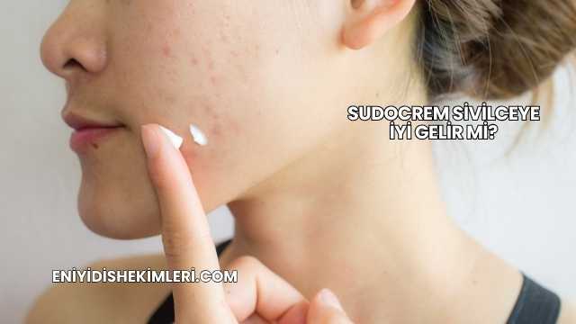 Sudocrem Sivilceye İyi Gelir mi?