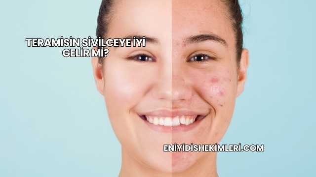 Teramisin Sivilceye İyi Gelir mi?