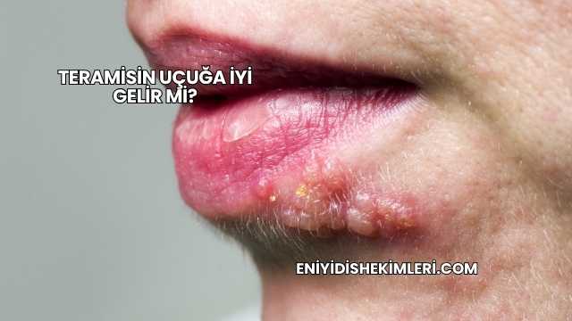 Teramisin Uçuğa İyi Gelir mi?