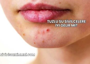 Tuzlu Su Sivilcelere İyi Gelir mi?