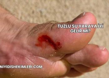 Tuzlu Su Yaraya İyi Gelir mi?