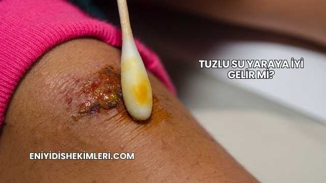 Tuzlu Su Yaraya İyi Gelir mi?