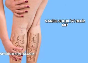 Varise Suluk İyi Gelir mi?