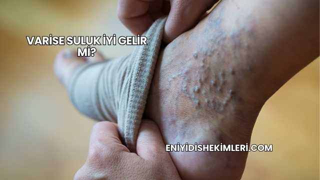 Varise Suluk İyi Gelir mi?