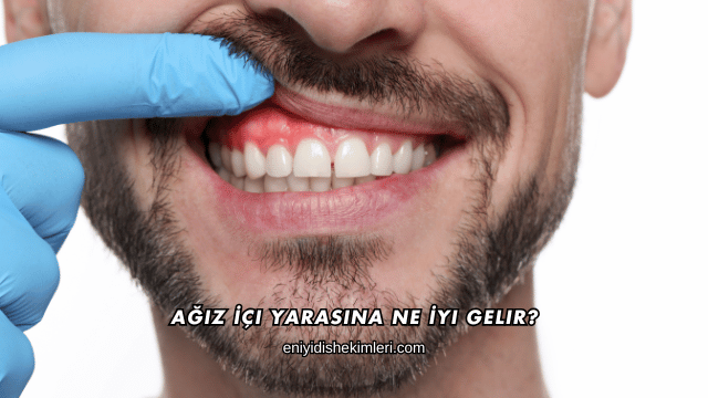 Ağız İçi Yarasına Ne İyi Gelir