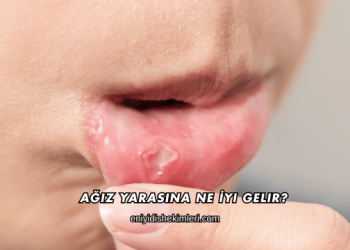 Ağız Yarasına Ne İyi Gelir?