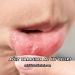Ağız Yarasına Ne İyi Gelir?