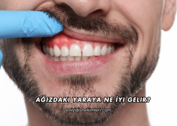 Ağızdaki Yaraya Ne İyi Gelir?