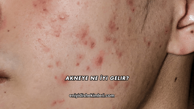 Akneye Ne İyi Gelir?