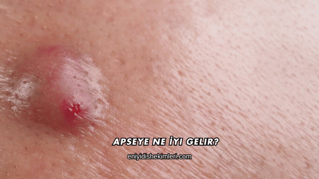 Apseye Ne İyi Gelir?