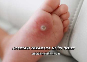 Ayaktaki Egzamaya Ne İyi Gelir?