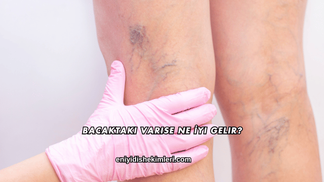 Bacaktaki Varise Ne İyi Gelir?