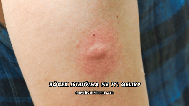 Böcek Isırığına Ne İyi Gelir?