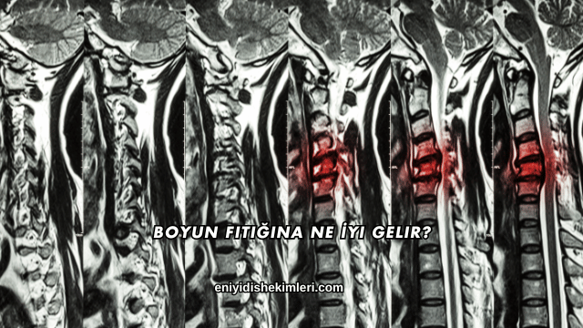 Boyun Fıtığına Ne İyi Gelir?