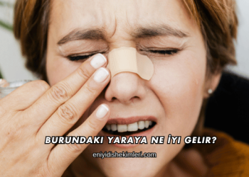 Burundaki Yaraya Ne İyi Gelir?