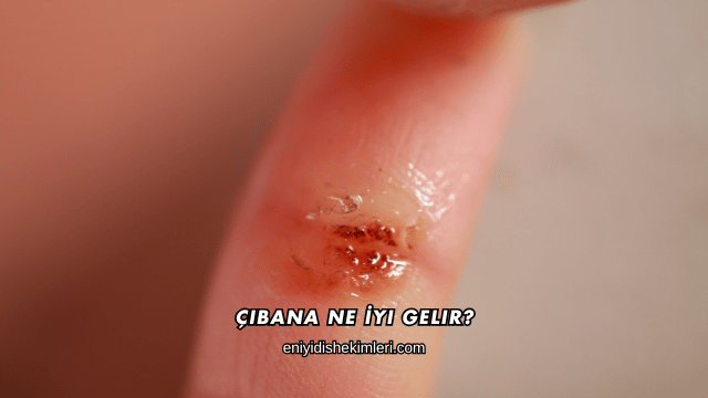 Çıbana Ne İyi Gelir