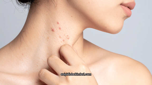 Çıbana Ne İyi Gelir