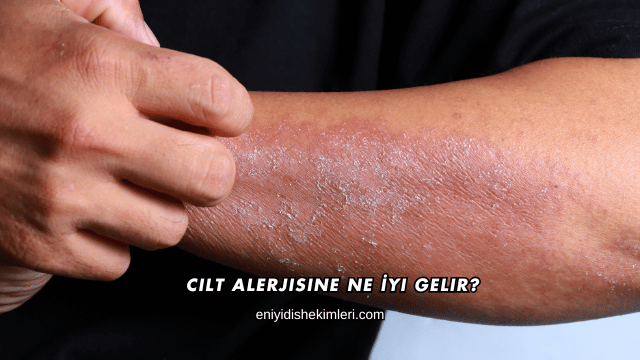 Cilt Alerjisine Ne İyi Gelir?