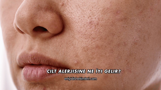 Cilt Alerjisine Ne İyi Gelir?