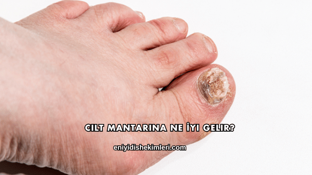 Cilt Mantarına Ne İyi Gelir?