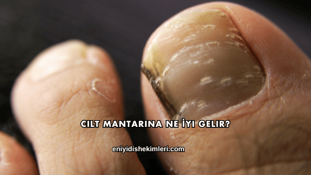 Cilt Mantarına Ne İyi Gelir?
