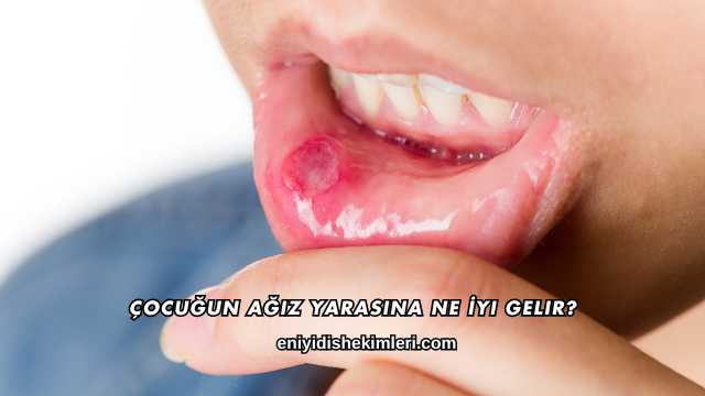 Çocuğun Ağız Yarasına Ne İyi Gelir?