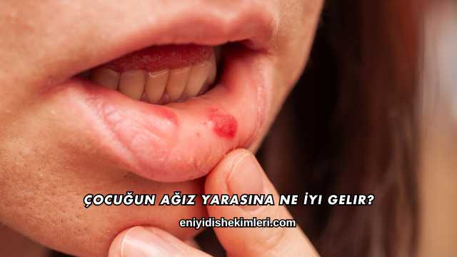 Çocuğun Ağız Yarasına Ne İyi Gelir?