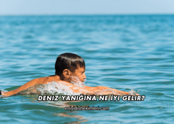 Deniz Yanığına Ne İyi Gelir?