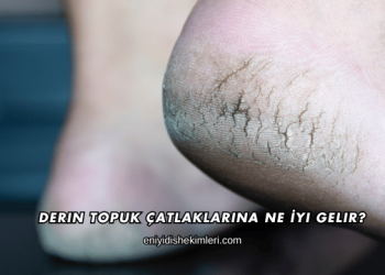 Derin Topuk Çatlaklarına Ne İyi Gelir?