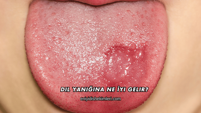 Dil Yanığına Ne İyi Gelir?