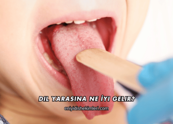 Dil Yarasına Ne İyi Gelir?