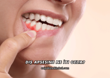 Diş Apsesine Ne İyi Gelir?