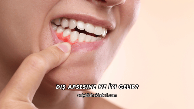 Diş Apsesine Ne İyi Gelir?
