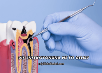 Diş Enfeksiyonuna Ne İyi Gelir?