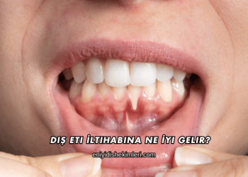 Diş Eti İltihabına Ne İyi Gelir?