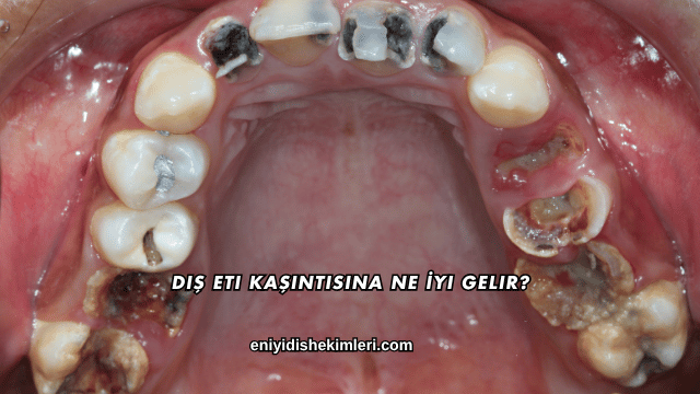 Diş Eti Kaşıntısına Ne İyi Gelir?
