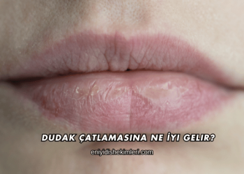 Dudak Çatlamasına Ne İyi Gelir?