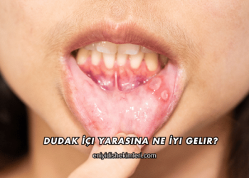 Dudak İçi Yarasına Ne İyi Gelir?