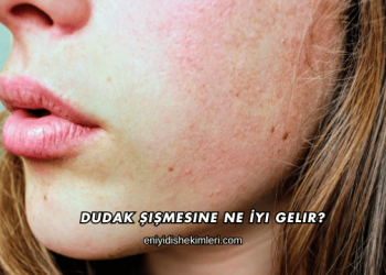 Dudak Şişmesine Ne İyi Gelir?