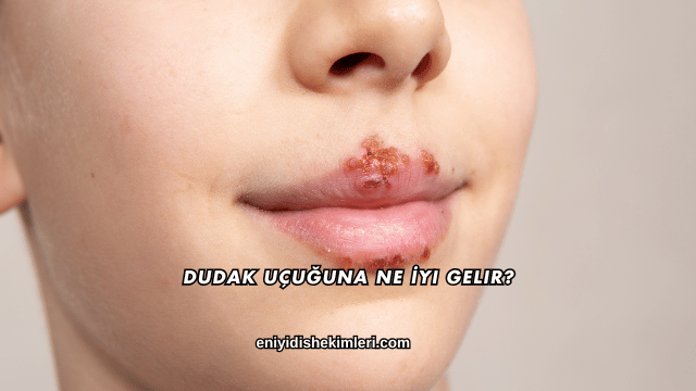 Dudak Uçuğuna Ne İyi Gelir?