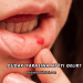 Dudak Yarasına Ne İyi Gelir?