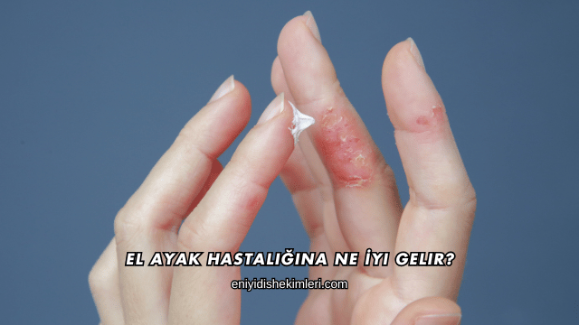 El Ayak Hastalığına Ne İyi Gelir?